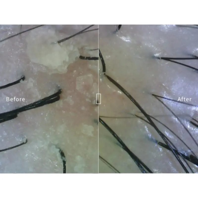 juliart dandruff before and after 582b0fae 6cef 4f65 894c 46bb2575c1e7